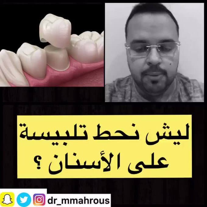تلبيس الأسنان ملخص