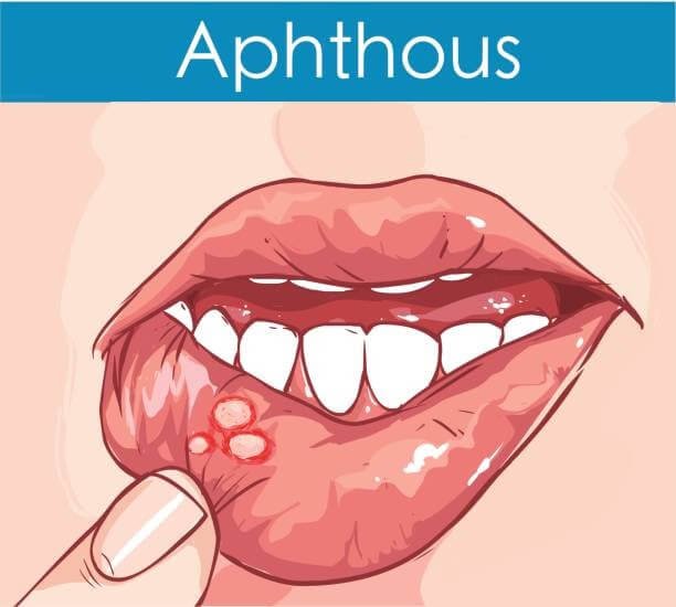 عن الـ Aphthous Ulcers ملخص
